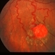 Capillary Hemongima Capillary Hemongima